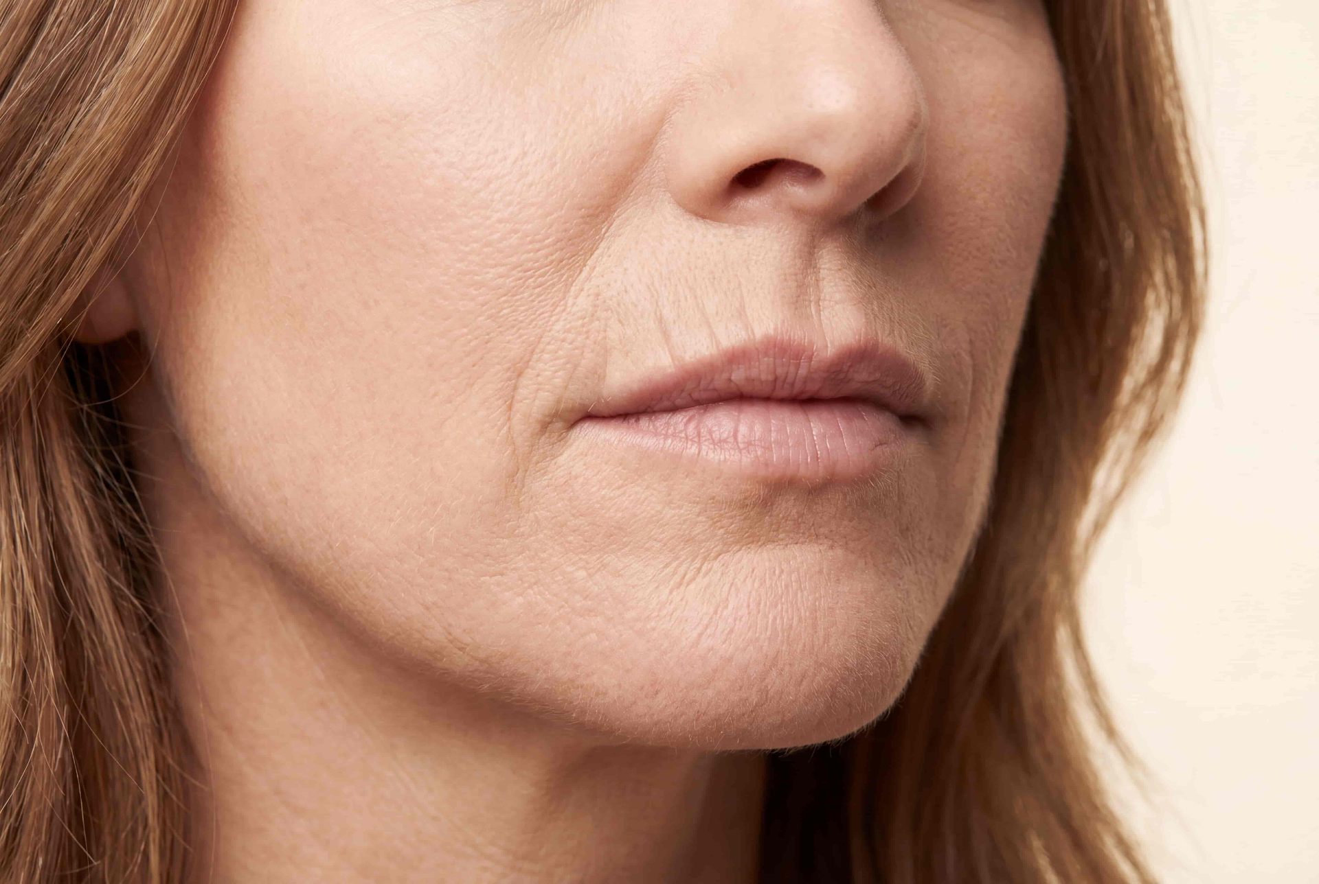 Perioral fine lines and volume loss from local estrogen depletion in the dermis