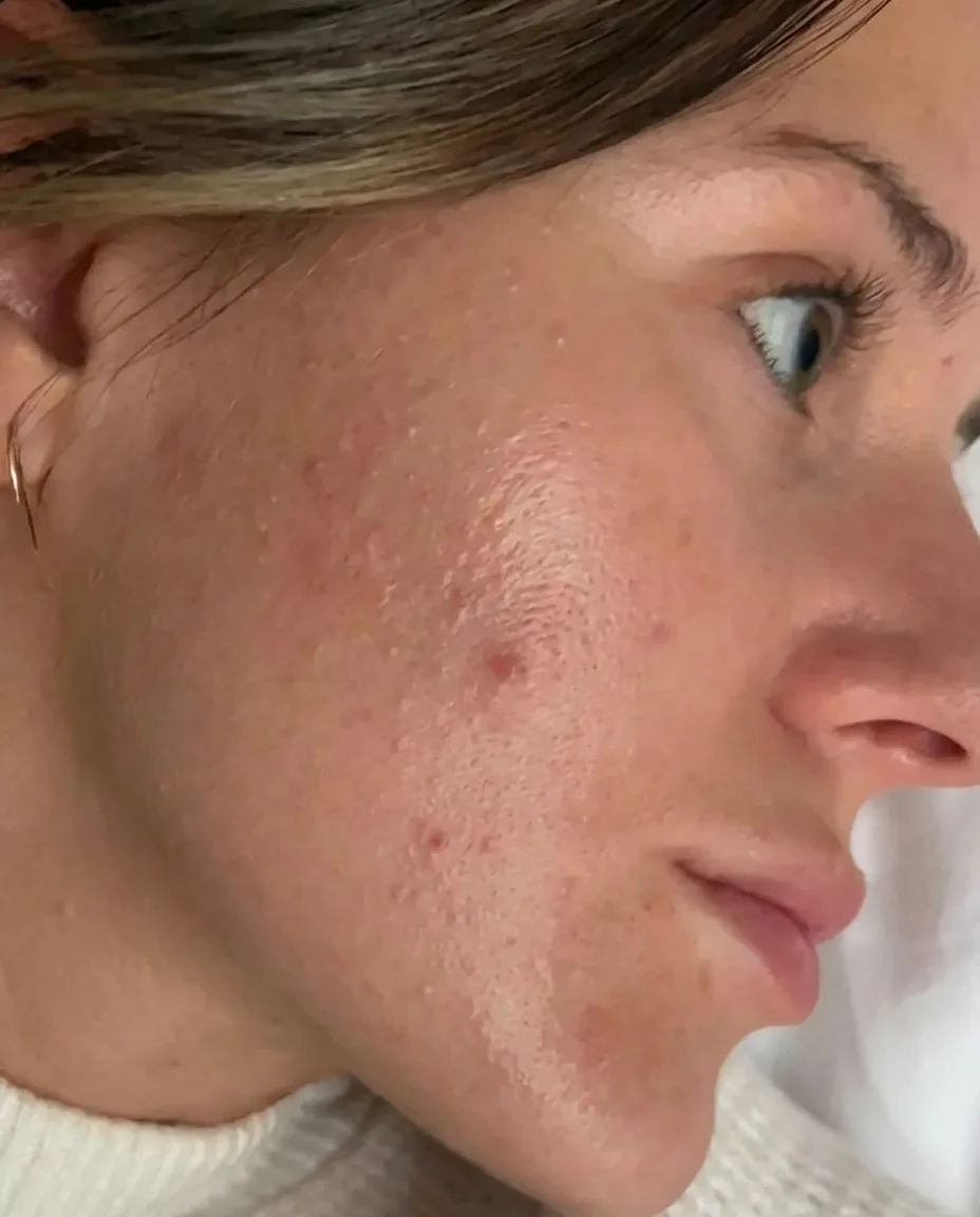 Tretinoin journey Starting Point