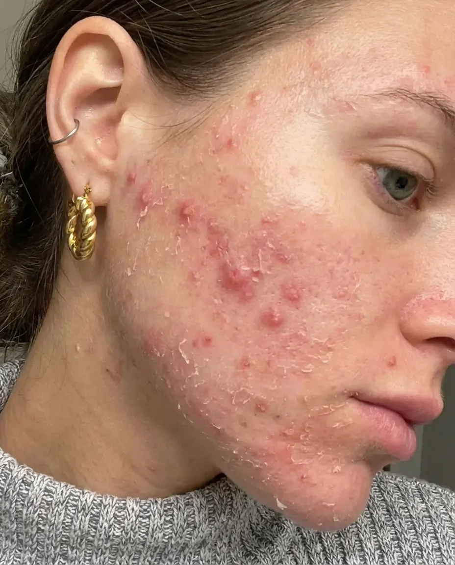 Tretinoin journey Week 4