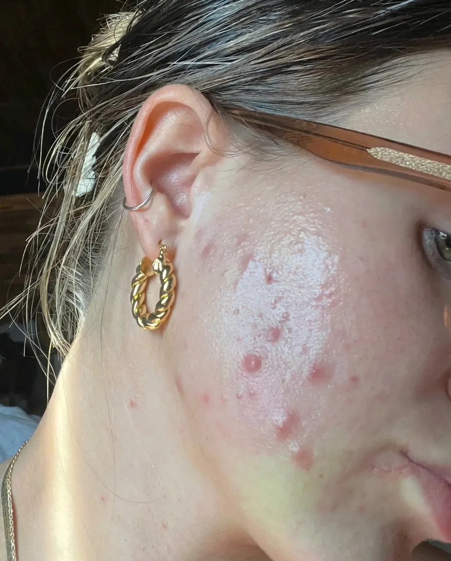 Tretinoin journey Week 6