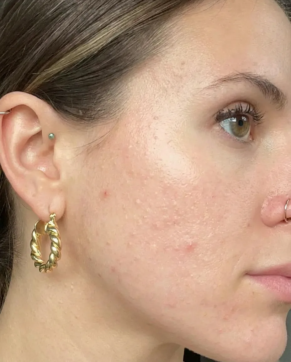 Tretinoin journey Week 8