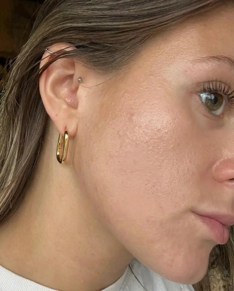 Tretinoin journey Week 12